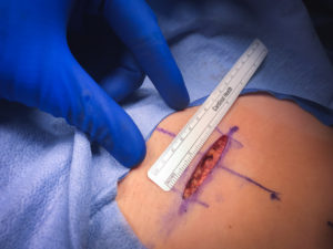 2 inch incision