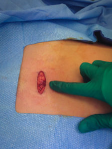 Small Incision